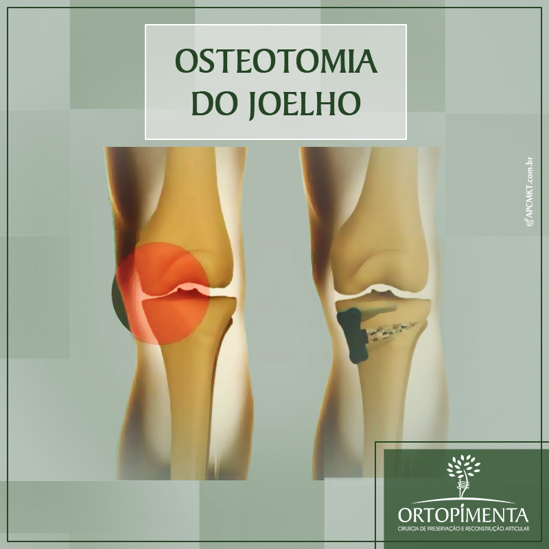 Osteotomia do Joelho ou Tibial - Ortopedia - Ortopimenta - Passos MG