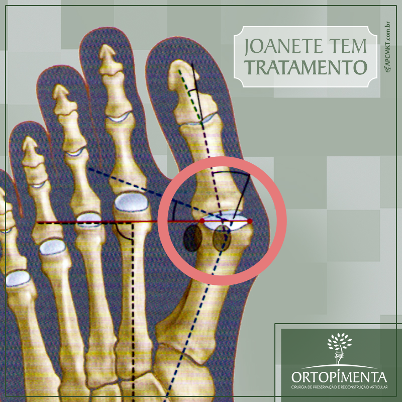 joanete tem tratamento - hallux valgus - ortopimenta - ortopedia - passos mg