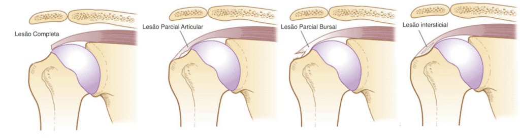 Lesões do Manguito Rotador